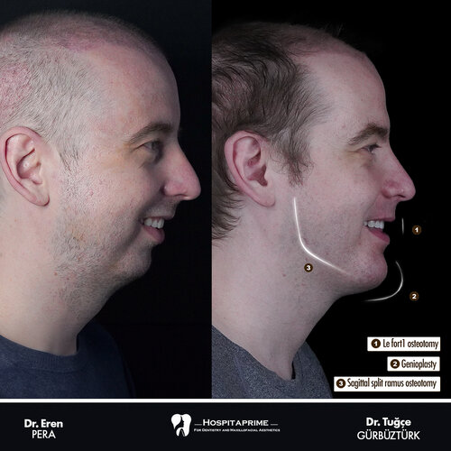 jaw-surgery-before-after-123.jpg