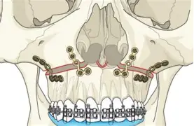 le fort 2 osteotomi için resim sonucu le fort 2 osteotomi için resim sonucu