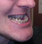 severe underbite için resim sonucu severe underbite için resim sonucu
