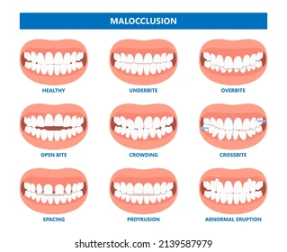 Mouth open deep bad bite 260nw 2139587979