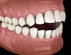 open bite için resim sonucu open bite için resim sonucu