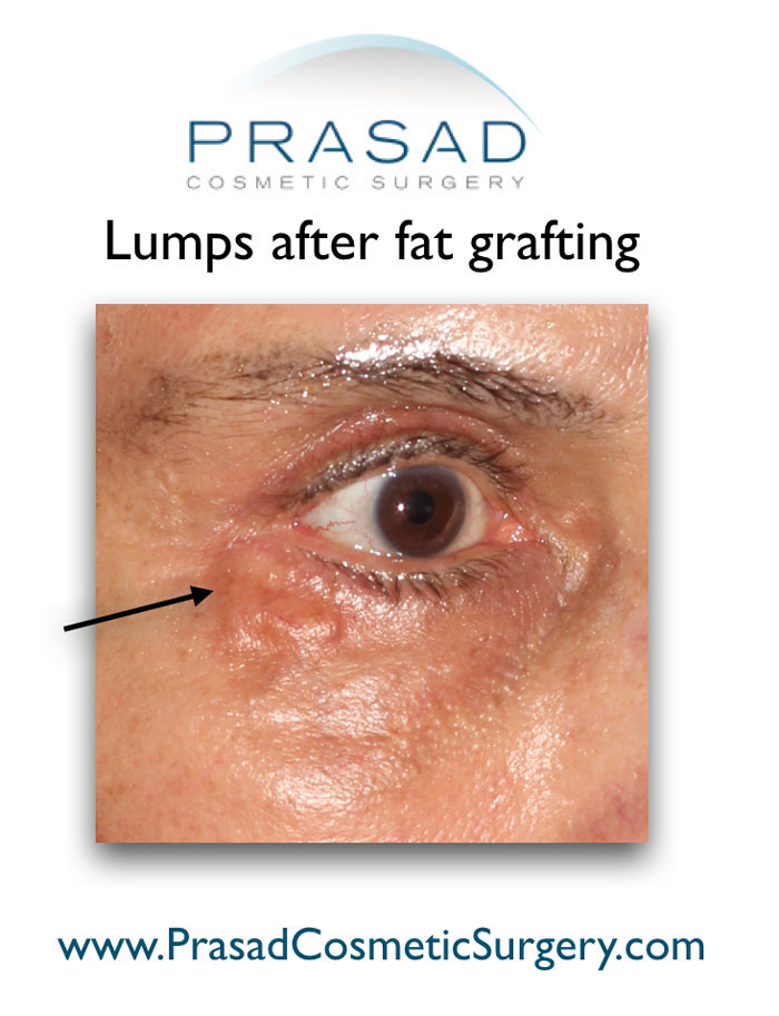 Lumps after fat grafting on the right eye mobile optimize