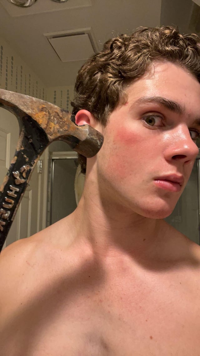4338963 my 4 month zygomatic growth from bonesmash v0 esjduk56gv0d1