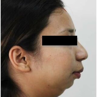 Preoperative clinical images receding chin with hypoplastic mandible with bird face Q320