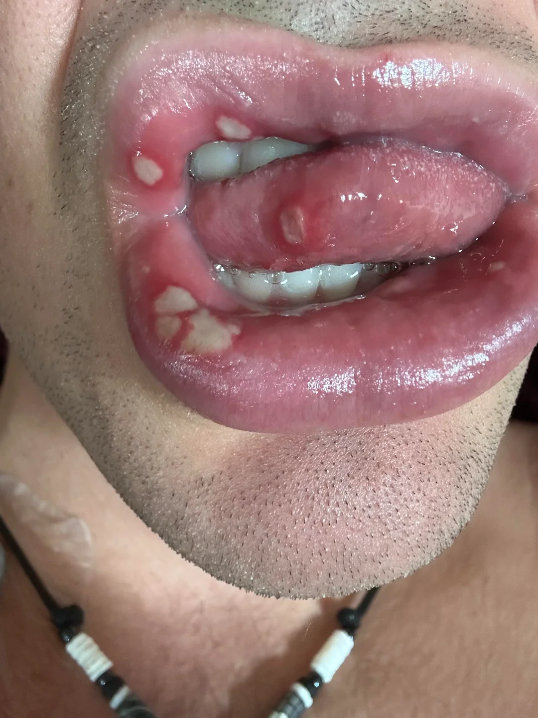 Worst ive ever had 12 sores at once v0 hudnwioo6j4c1