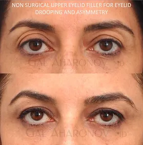 Eyelid filler hollowness around eyes fat