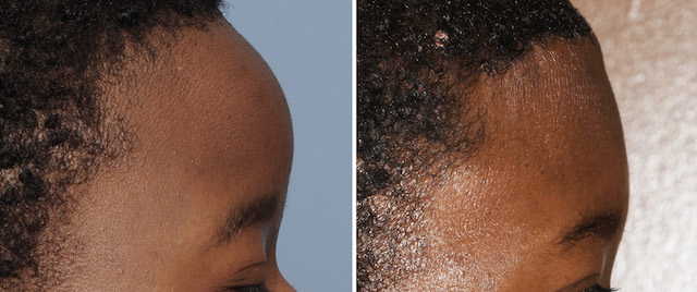 Frontal Bossing Forehead Reduction result side view Dr Barry Eppley Indianapolis 1