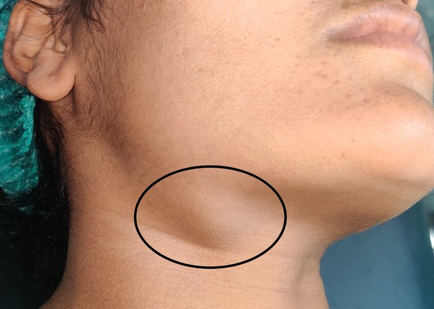 Clinical picture showing right submandibular swelling