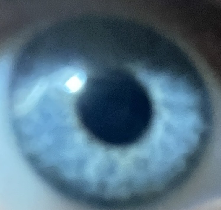 Eye
