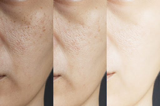 Harley street skin blog Harley street skin blog
