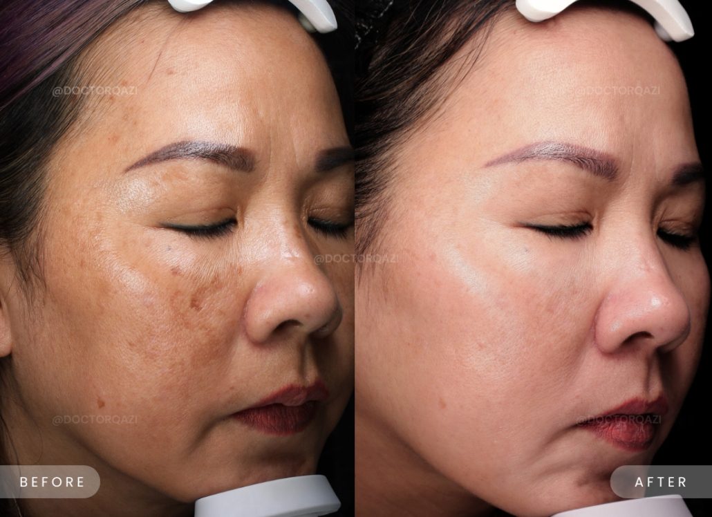 Hyperpigmentation Treatment Gallery Large 1030x748 Hyperpigmentation Treatment Gallery Large 1030x748