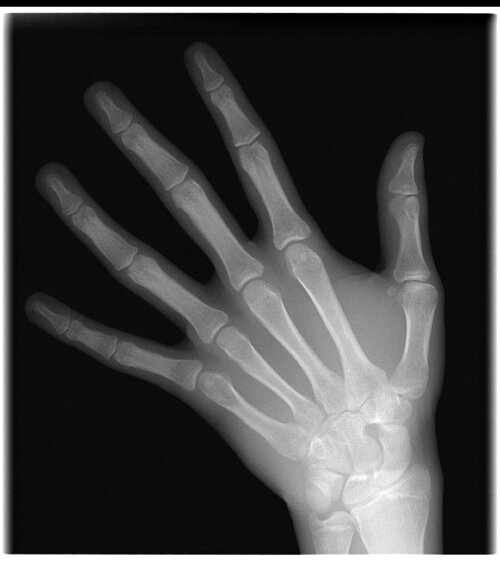 xray af hånd.jpg
