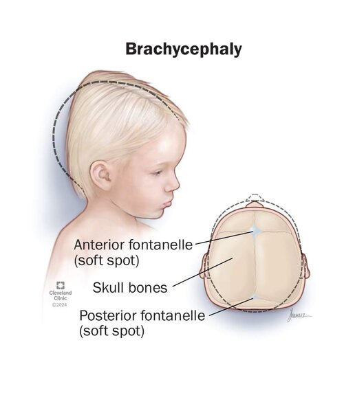 Brachycephaly illustration