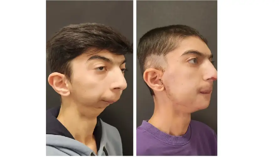 before-and-after-tmj-surgery-scar.jpg.webp