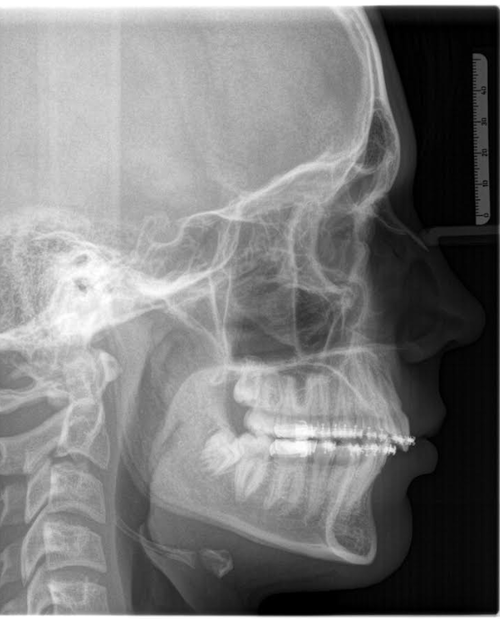 Side profile xray.png