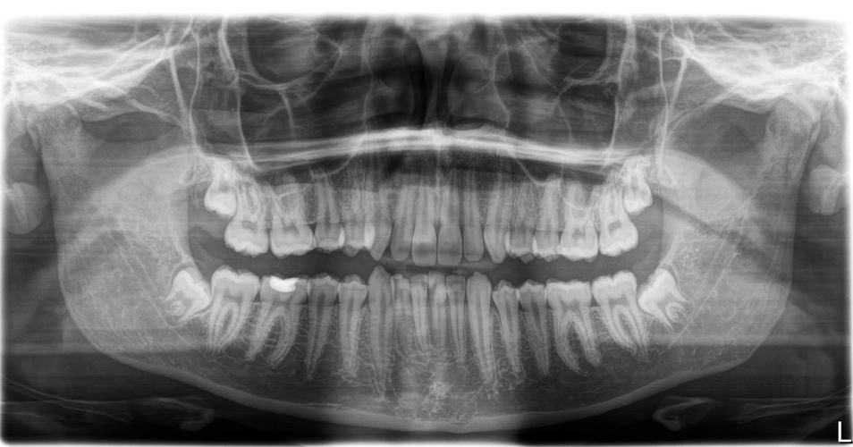 front profile xray.png