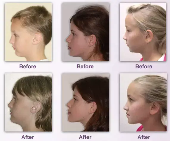 Beforeafter