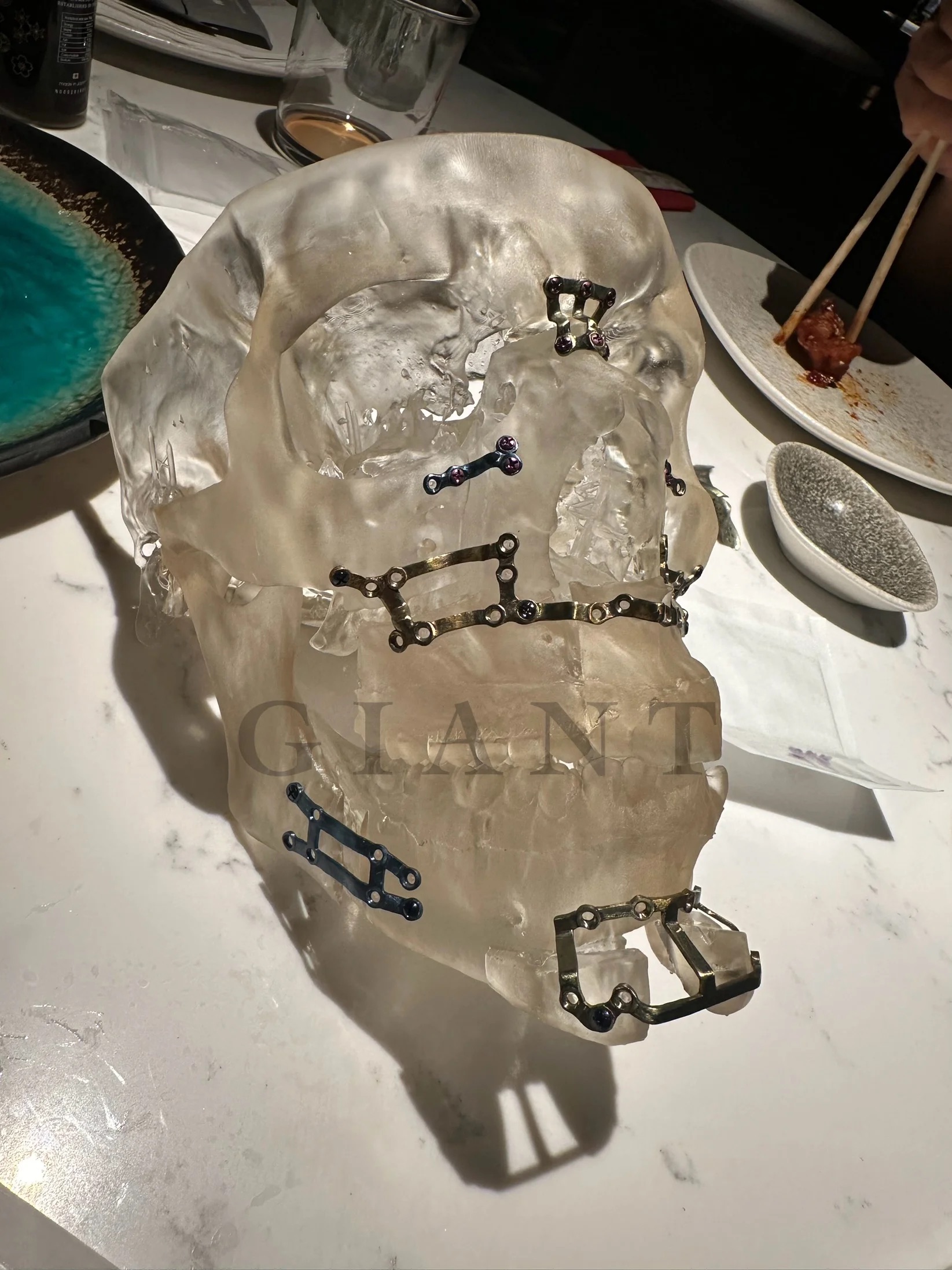 Incels designer executed lefort 2 on non syndromic patient v0 nd39348vcfmd1