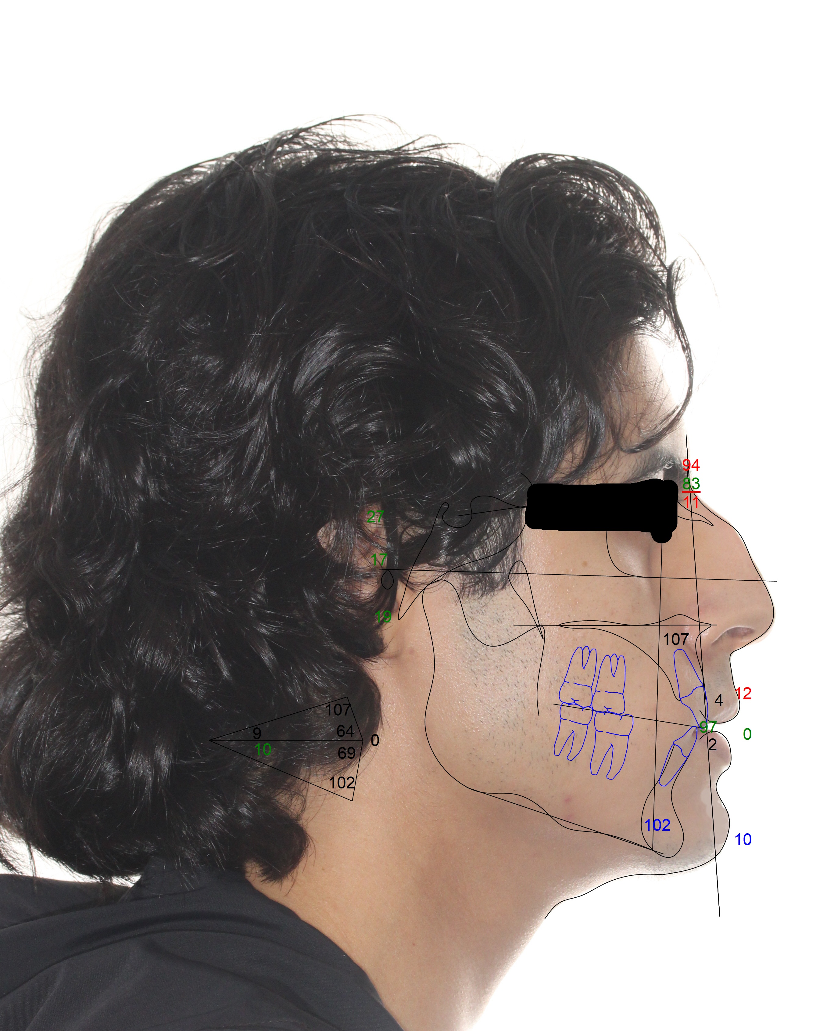 5388859 So Maxilla Mandible and Chin