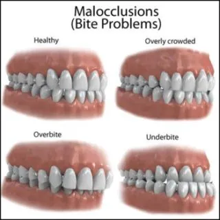 Bite problems malocclusions large e1485816981447 320x320