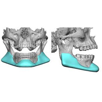 Custom Jawline Implant Replacement for Medporm Implants Dr Barry Eppley Indianapolis 350x350