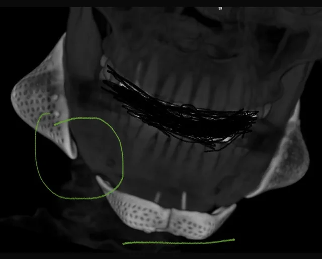 Warning beware of surgeon celal candirli and giant implants v0 jwx7bpqidl2f1