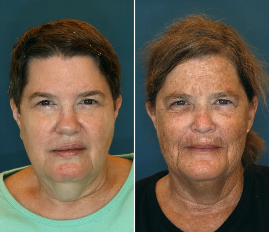 Since her 20s, Susan (right) has spent as much time as she could in the sun (she has plenty of opportunity on Florida’s east coast, where she moved more than a decade ago). Jeanne, meanwhile, has aimed for “as little exposure as possible.”
