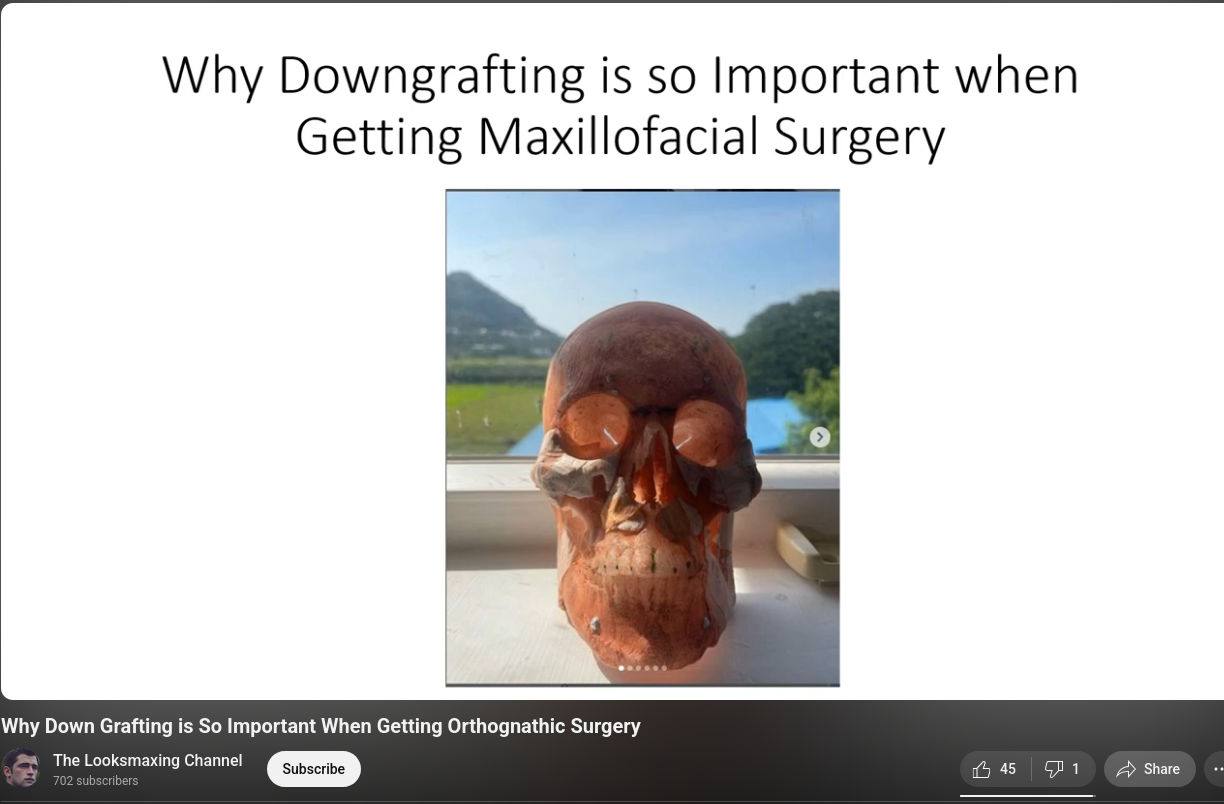 Screenshot 2025 10 10 at 21 26 52 Why Down Grafting is So Important When Getting Orthognathic Screenshot 2025 10 10 at 21 26 52 Why Down Grafting is So Important When Getting Orthognathic