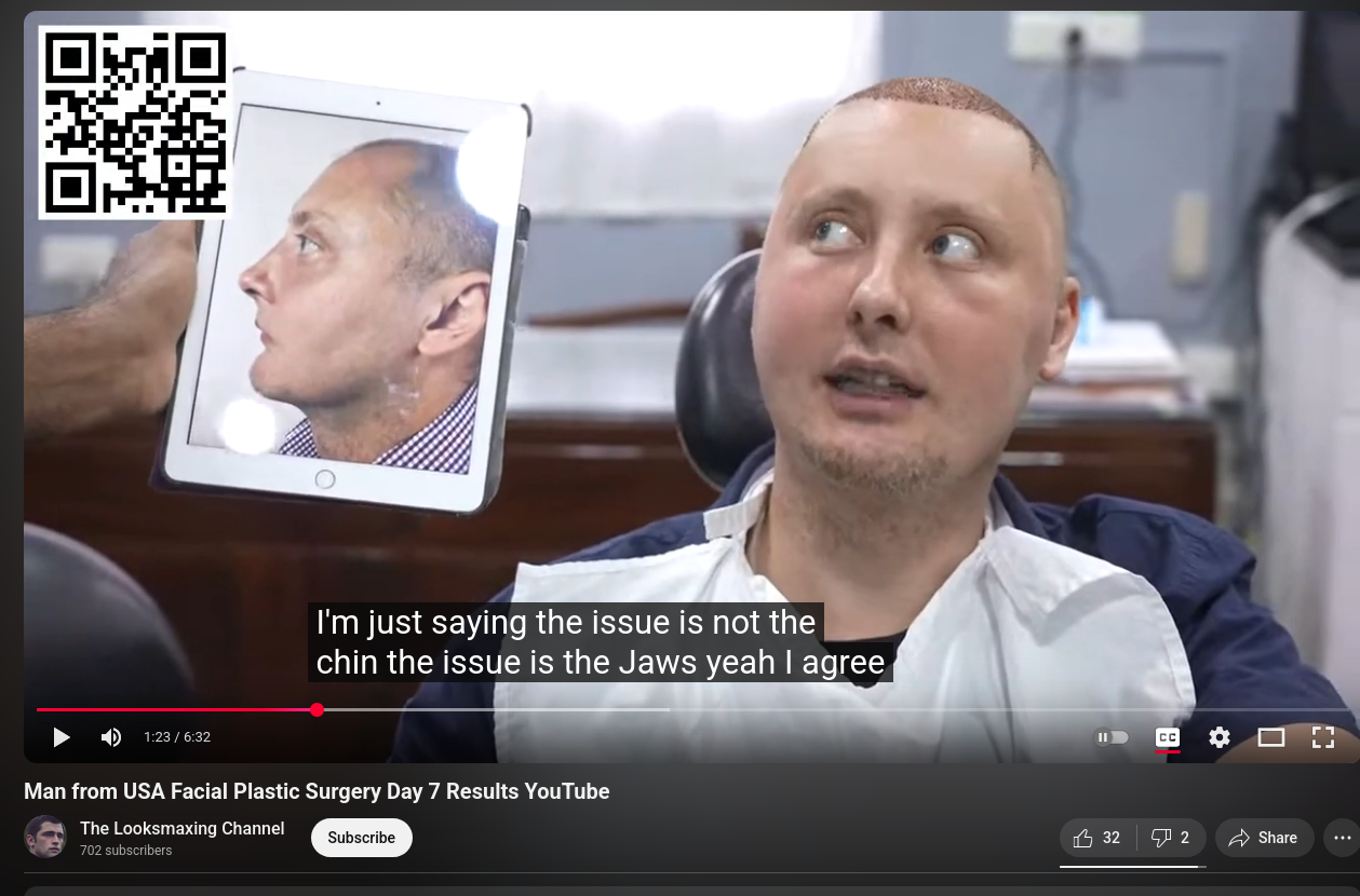 Screenshot 2025 10 10 at 21 28 27 Man from USA Facial Plastic Surgery Day 7 Results YouTube Screenshot 2025 10 10 at 21 28 27 Man from USA Facial Plastic Surgery Day 7 Results YouTube