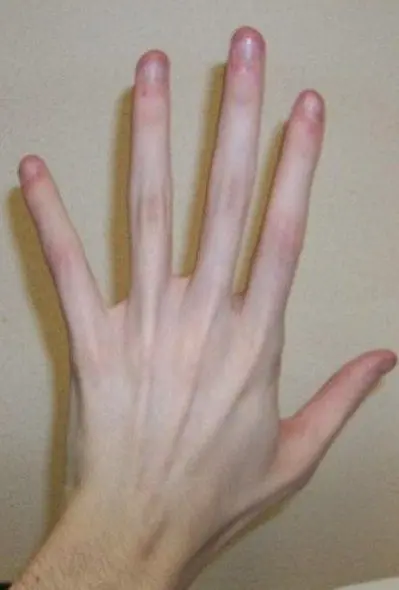 Marfan syndrome arachnodactyly finger spider veins Marfan syndrome arachnodactyly finger spider veins