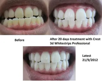 Kuvatulokset haulle teeth whitening strips before and after Kuvatulokset haulle teeth whitening strips before and after