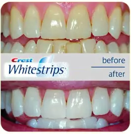 Kuvatulokset haulle teeth whitening strips before and after Kuvatulokset haulle teeth whitening strips before and after