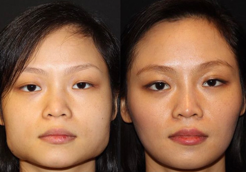 Carson Non Surgical Jawline Reduction Atlanta