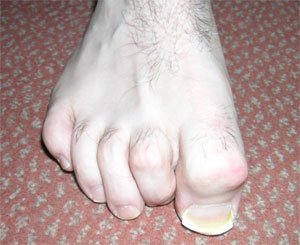 Clawtoe