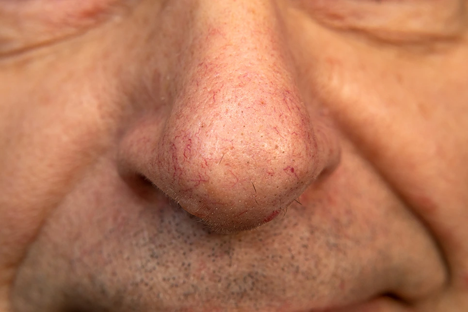 Telangiectasia on the nose2 Telangiectasia on the nose2