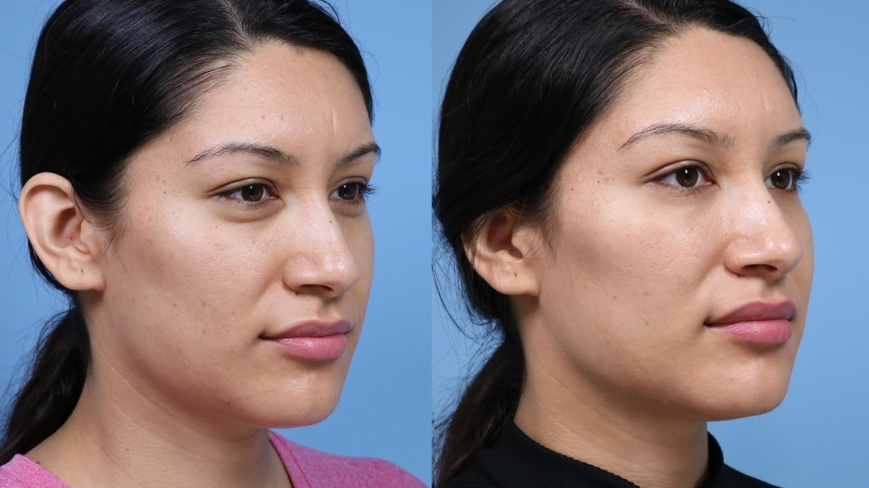 Fix undereye Fix undereye