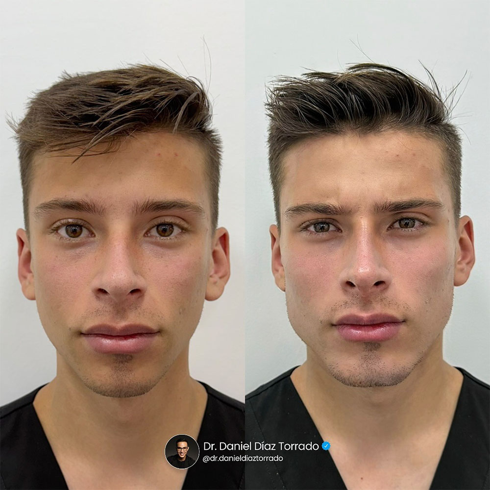 688b5c42efe2a55934466e3c facial masculinization fillers 3 688b5c42efe2a55934466e3c facial masculinization fillers 3