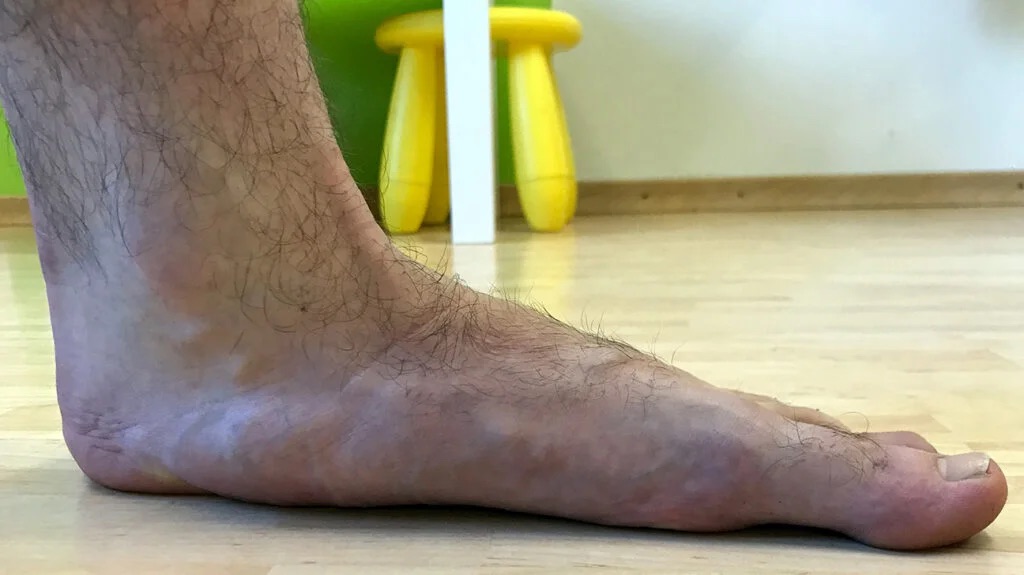 4 Flat feet left 1024x575 4 Flat feet left 1024x575