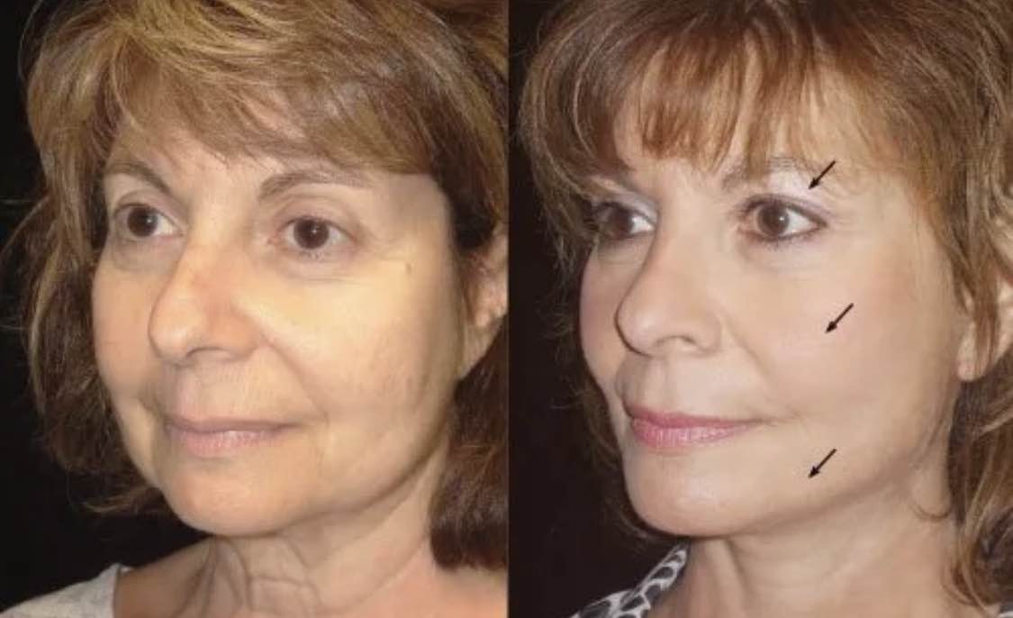 Facial fat grafting