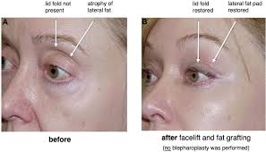 Periorbital Fat Grafting | Plastic ...