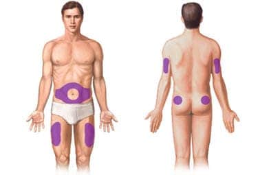 Subcutaneous testosterone injection areas