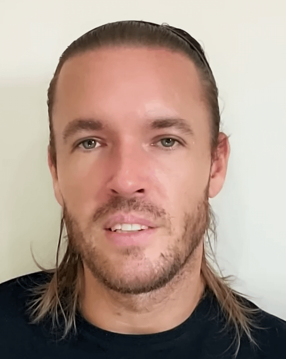 Goatis youtuber hair transplant very good transplant v0 t2j9nehazlle1