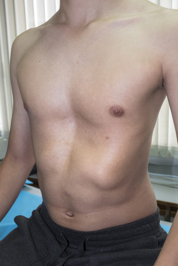 Generic Pectus excavatum image