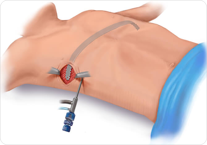 Pectus repair nuss procedure