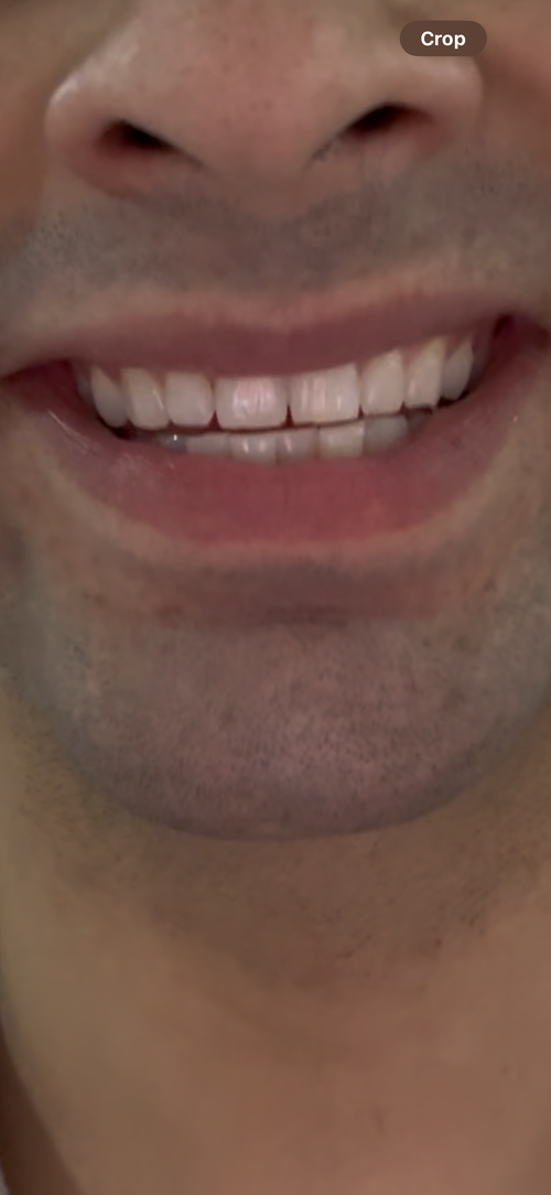 Pre op smile