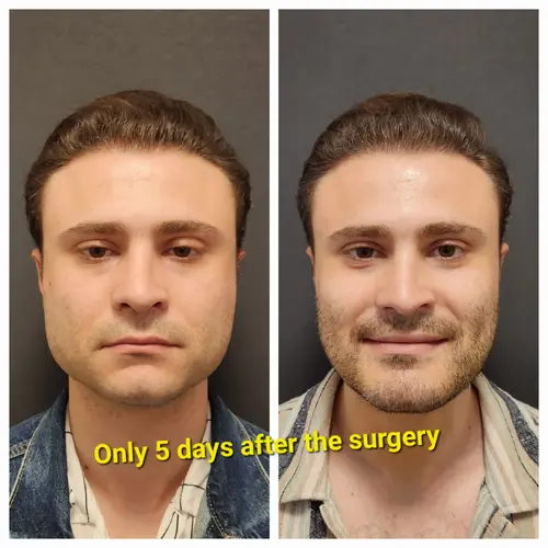 jawline-implant-cost-scaled.jpg.webp