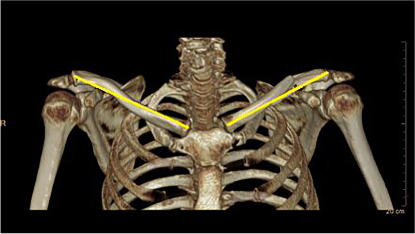 Measurement of clavicle length by computed tomography