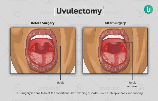 Uvulectomy procedure purpose results cost price in hindi