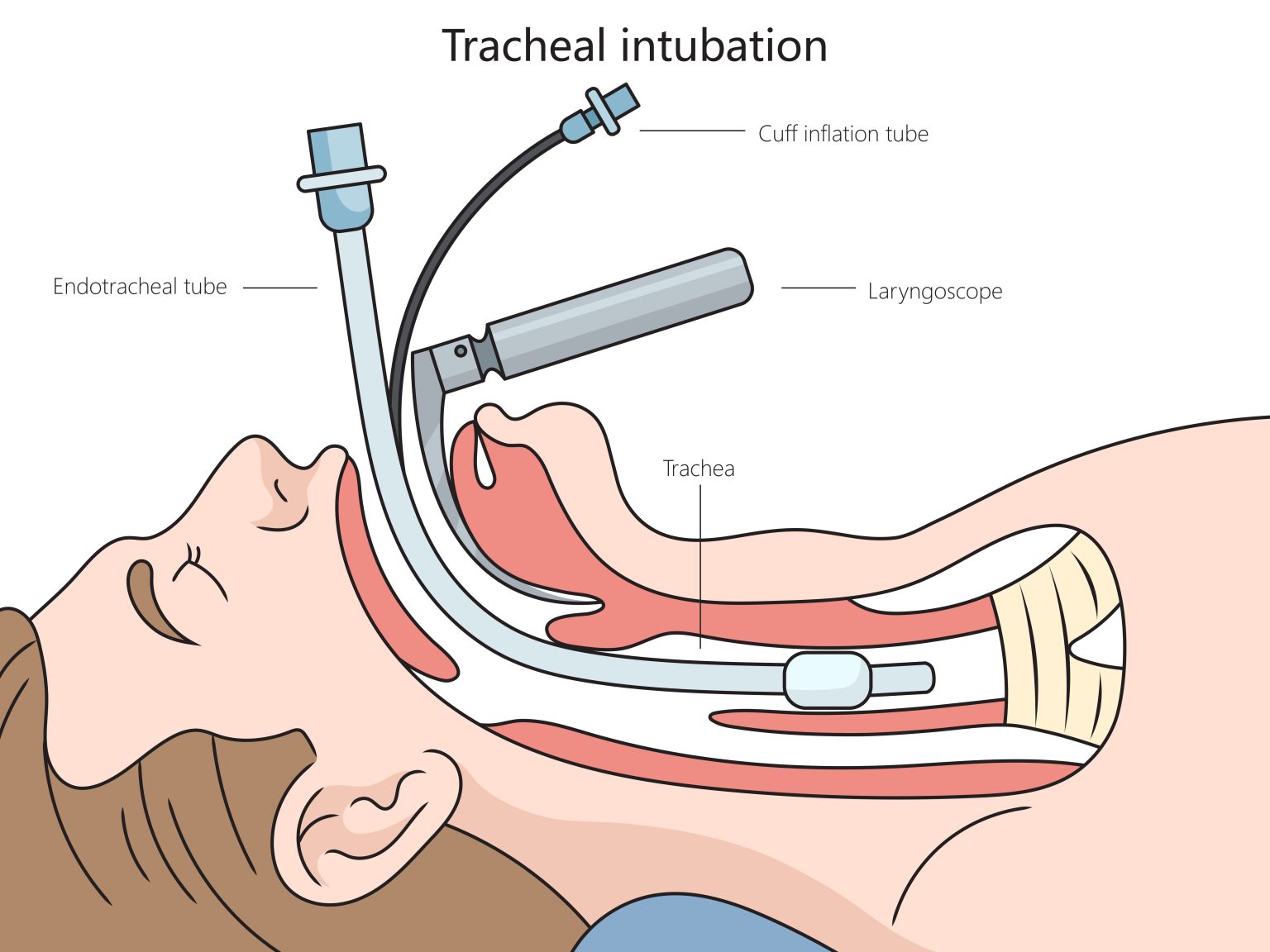 Tracheal Intubation 1 1536x1152