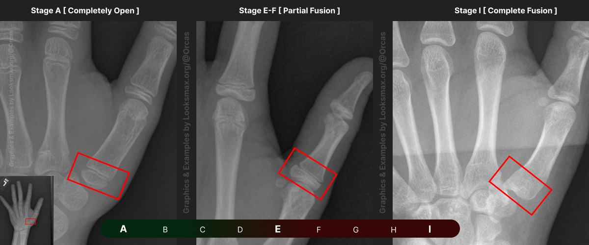 Template 3  Bonetype  1st Metacarpal thumb